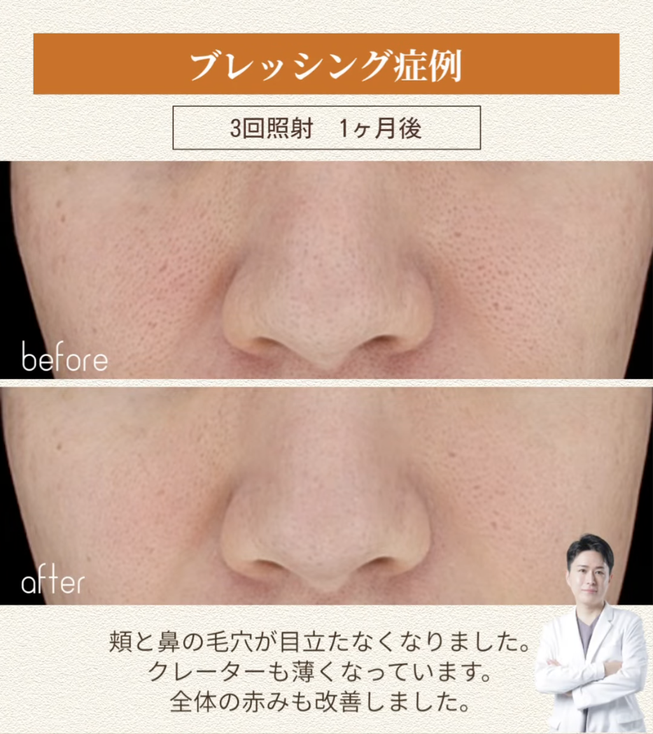 ブレッシング3回照射で頬と鼻の開き毛穴・クレーター・赤みを改善した症例（1ヶ月後） 画像3
