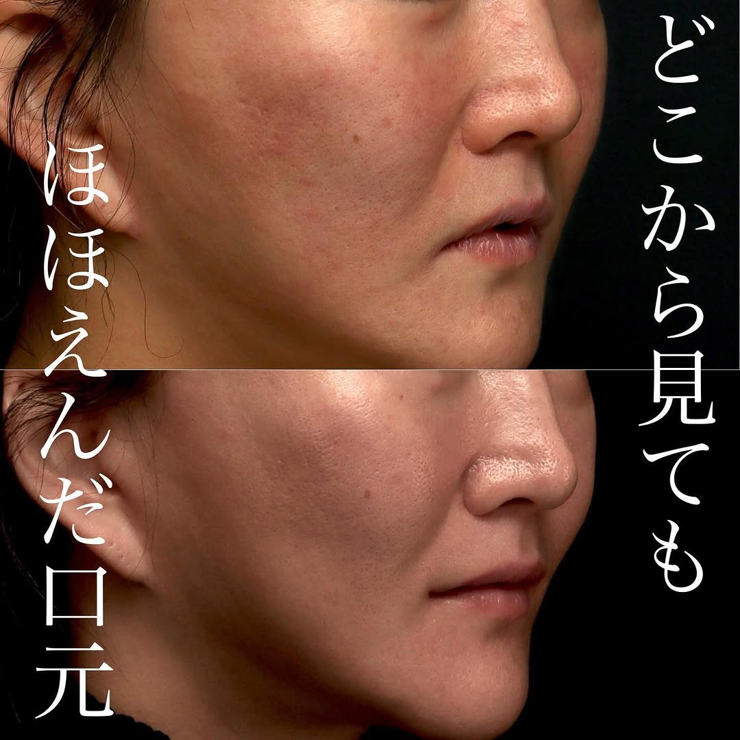 口角挙上で「口角が下がっていない」自然な口元の印象を整えた症例 画像2