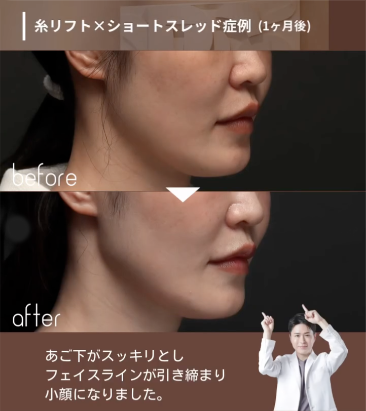 糸リフト＋ショートスレッドであご下のもたつきを引き締め横顔の輪郭を整えた症例（1ヶ月後） 画像2