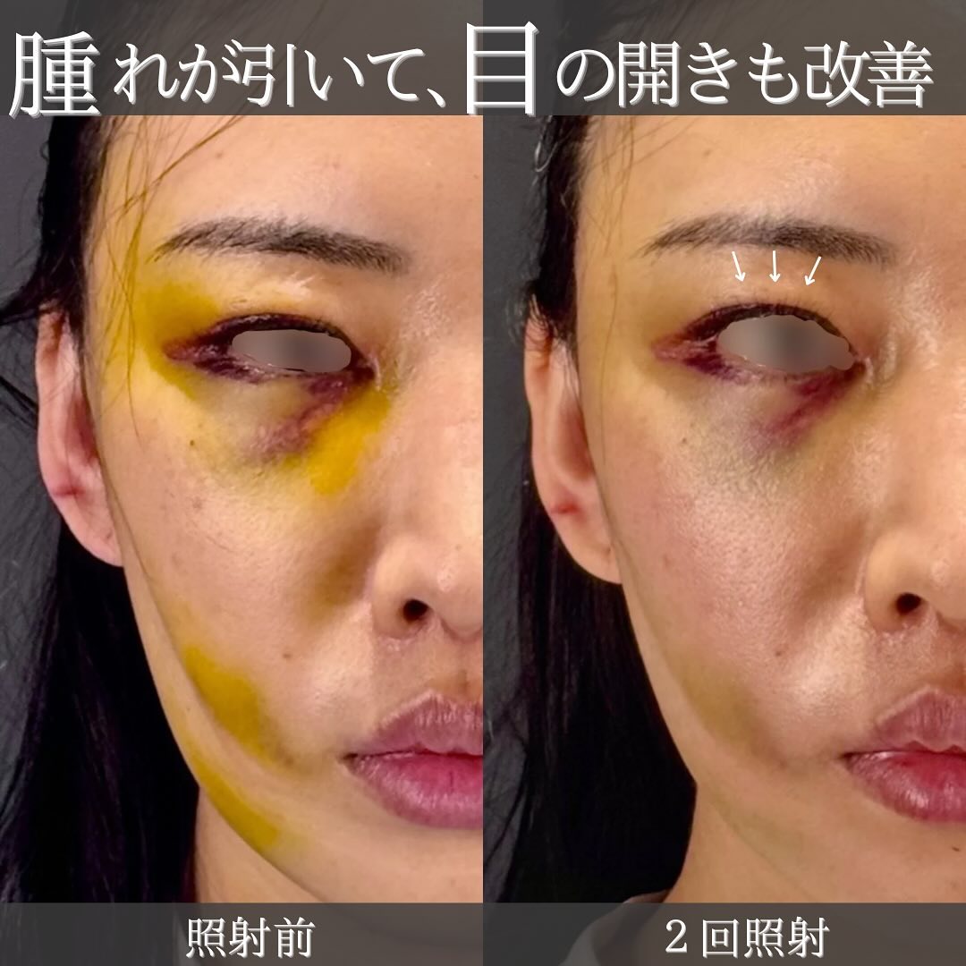 KOライト2日連続照射で他院フェイスリフト後の内出血と腫れを大幅に改善した症例 画像2