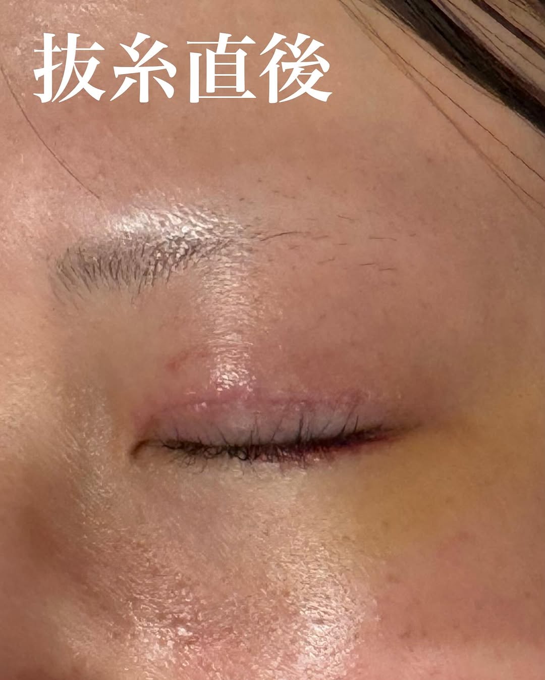 眼瞼下垂手術で黒目全体が見えるようになりまつ毛も上向きになった症例（術後1週間） 画像2