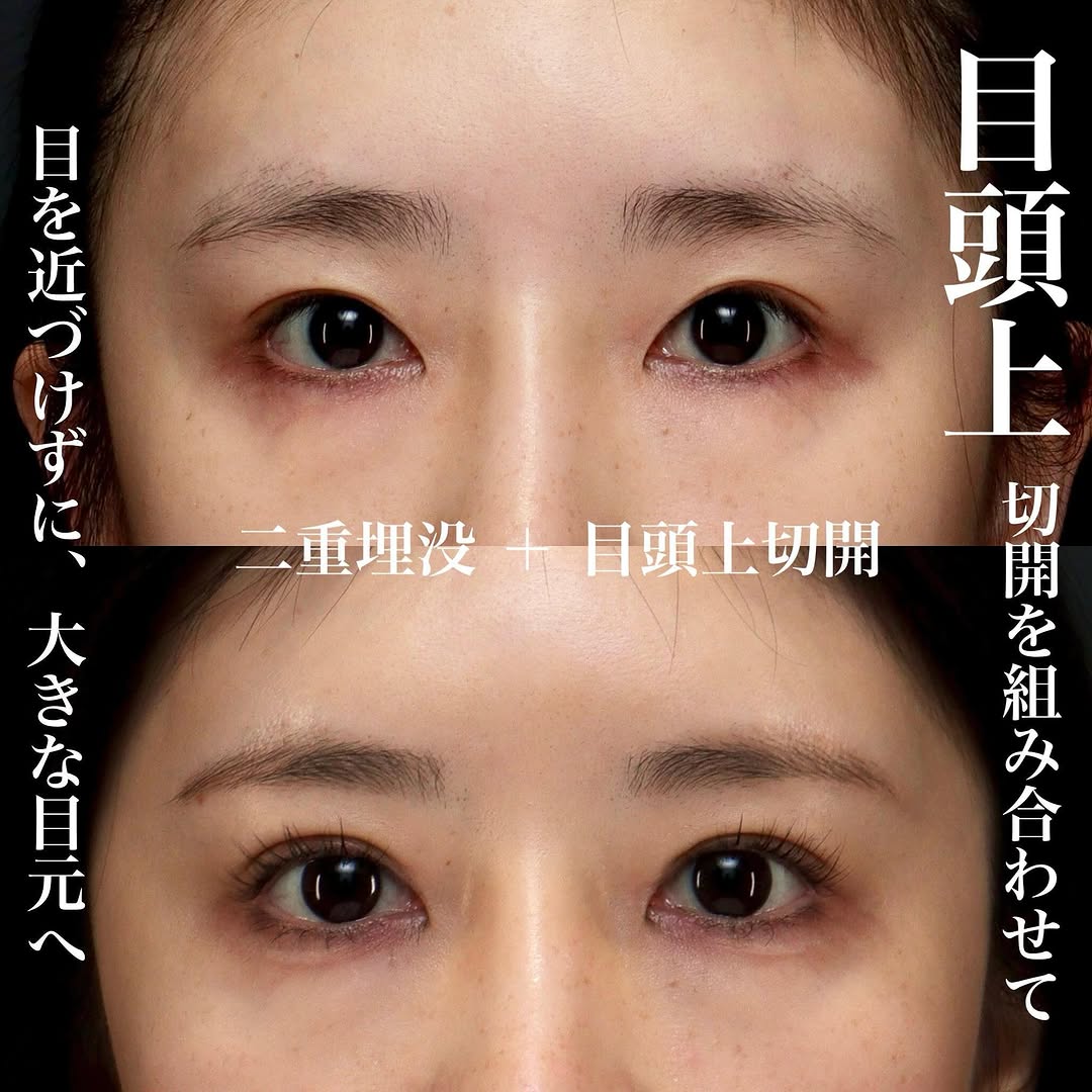 目頭上切開＋二重埋没で目と目の距離を保ちながら目元を大きく見せた症例