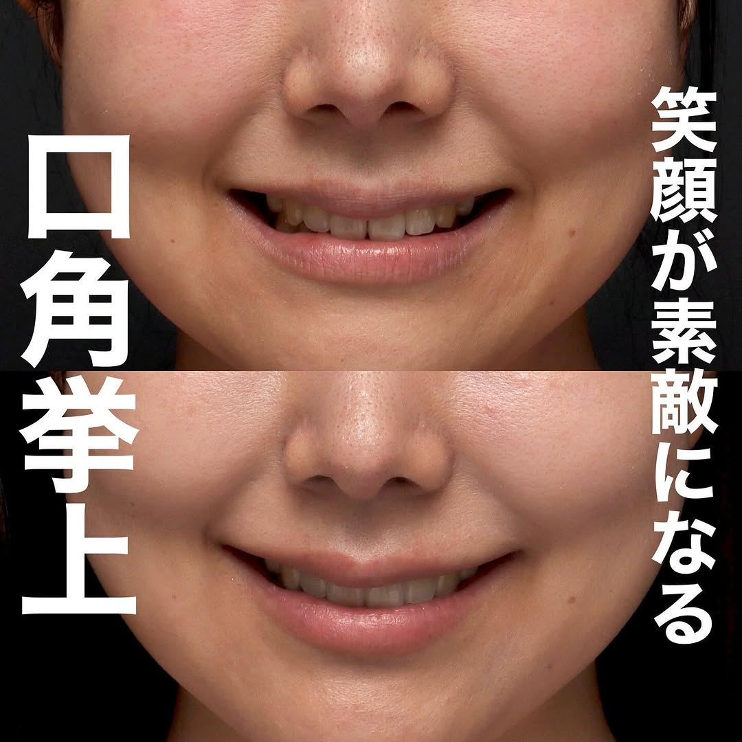 口角挙上で笑顔としゃべりやすさも改善した術後3ヶ月の長期経過症例