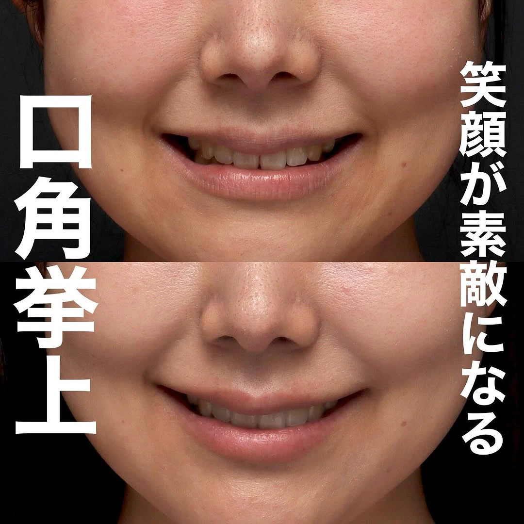 口角挙上で笑顔としゃべりやすさも改善した術後3ヶ月の長期経過症例