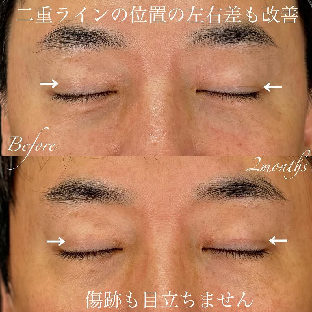 二重全切開で二重ラインの左右差と余分なラインを改善した症例（術後2ヶ月） 画像3