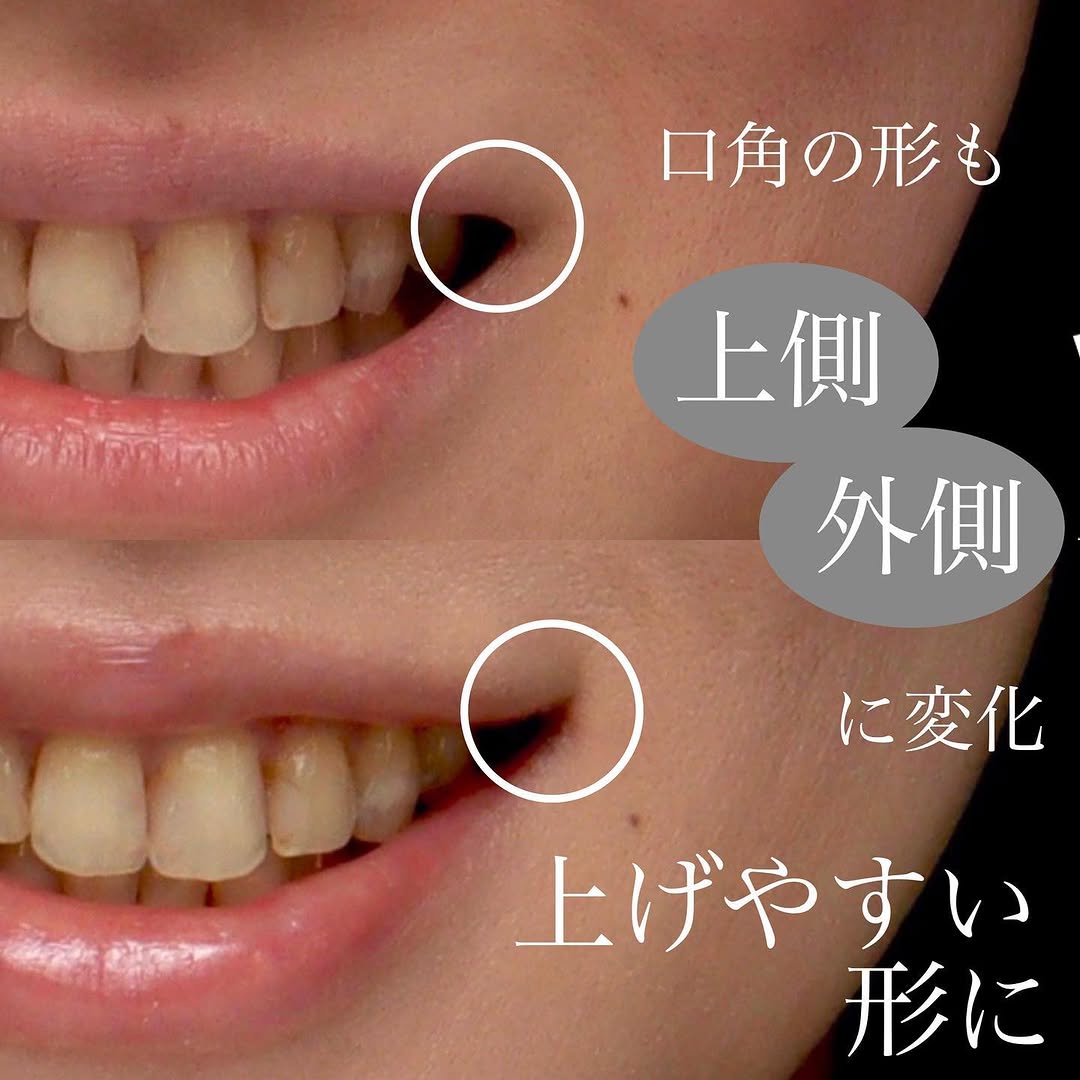 口角挙上で笑いやすさと口角の上がりを同時に改善した症例 画像5
