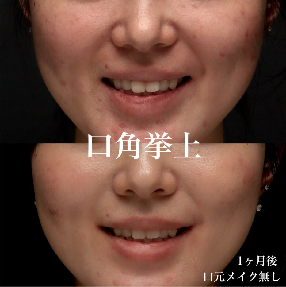 口角挙上で口角のつっぱりを解除し無理なく自然に笑える口元にした症例（術後1ヶ月）