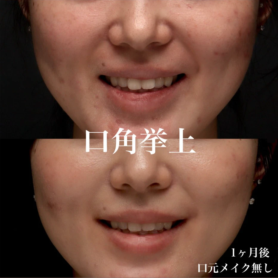 口角挙上で口角のつっぱりを解除し無理なく自然に笑える口元にした症例(術後1ヶ月)