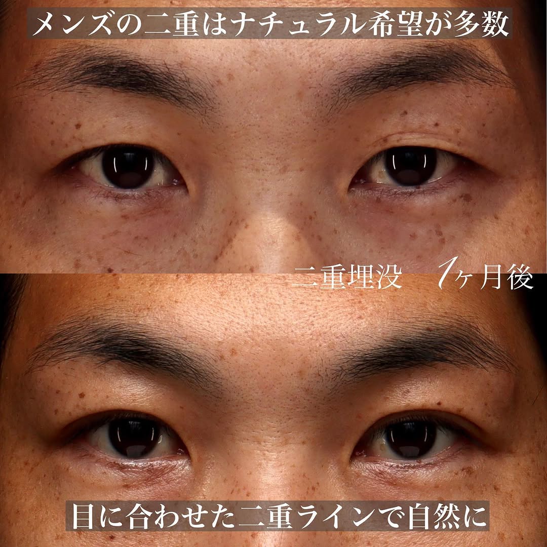 男性の二重埋没で左右差を改善し精悍な目元に（術後1ヶ月） 画像2