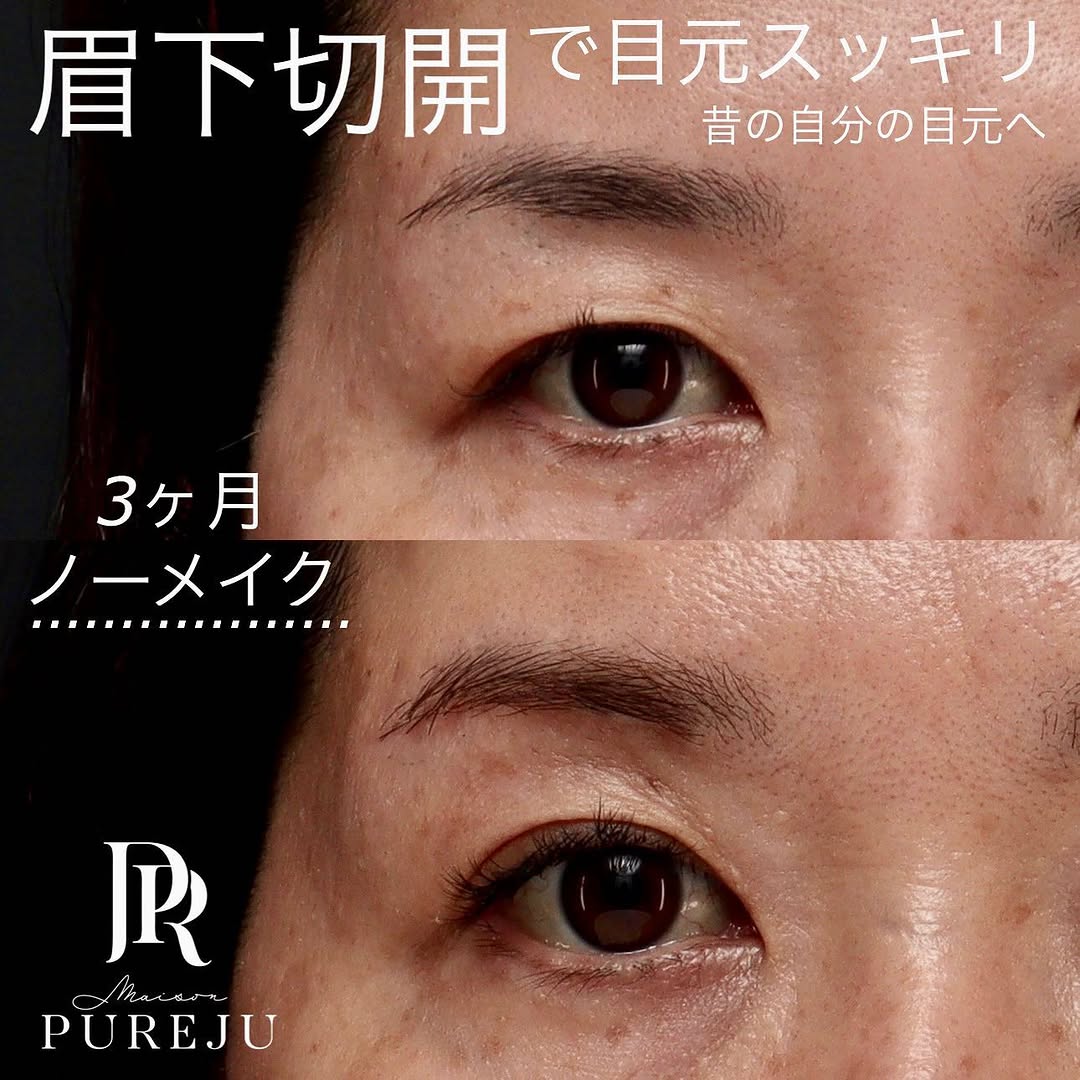 眉下切開で埋もれた二重とまつ毛を復活させ昔の目元に戻した症例（術後3ヶ月）
