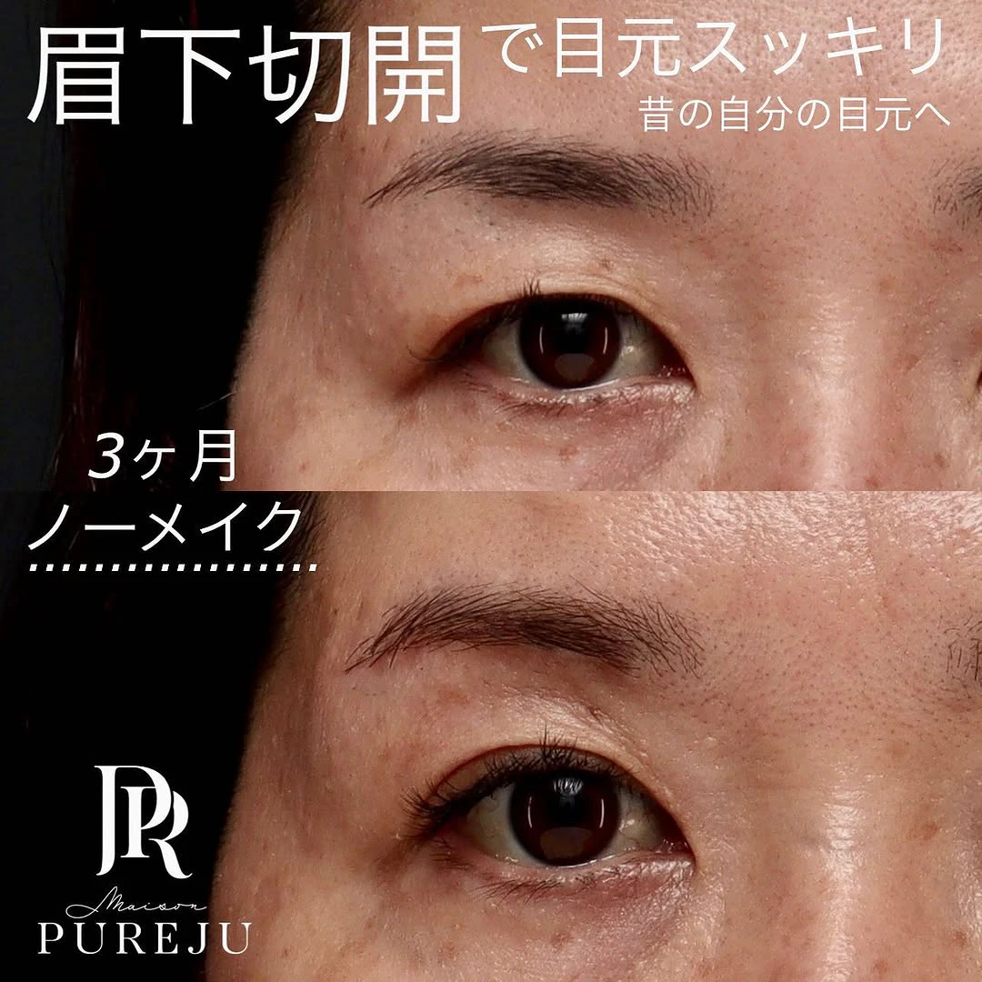 眉下切開で埋もれた二重とまつ毛を復活させ昔の目元に戻した症例(術後3ヶ月)
