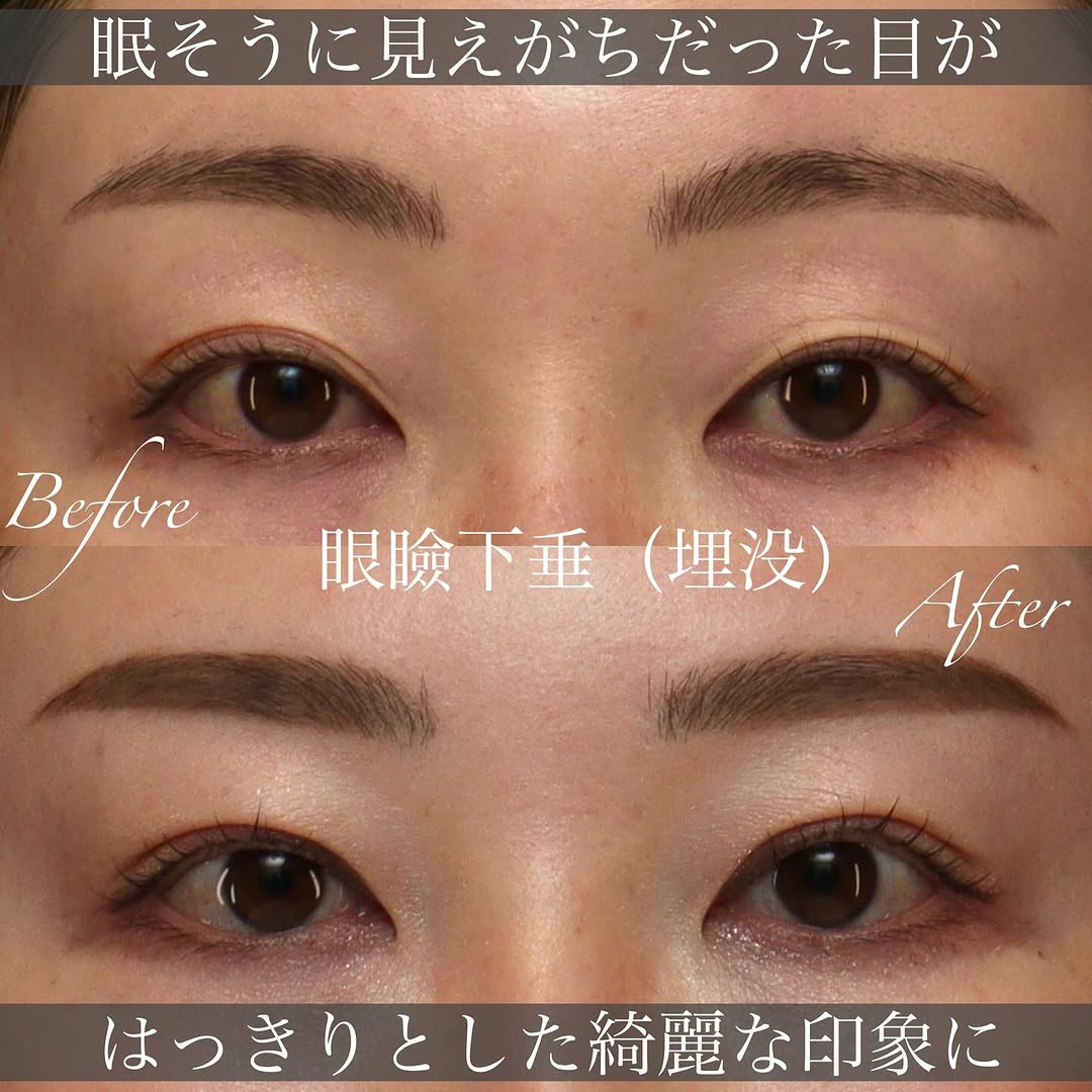 眼瞼下垂の切開法・埋没法の違いと手術の変化を解説した症例