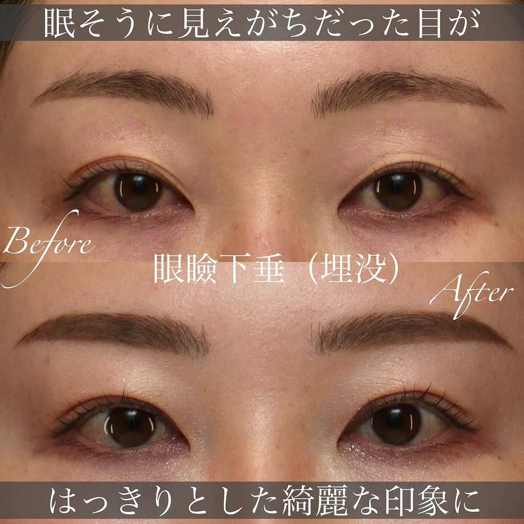 眼瞼下垂の切開法・埋没法の違いと手術の変化を解説した症例