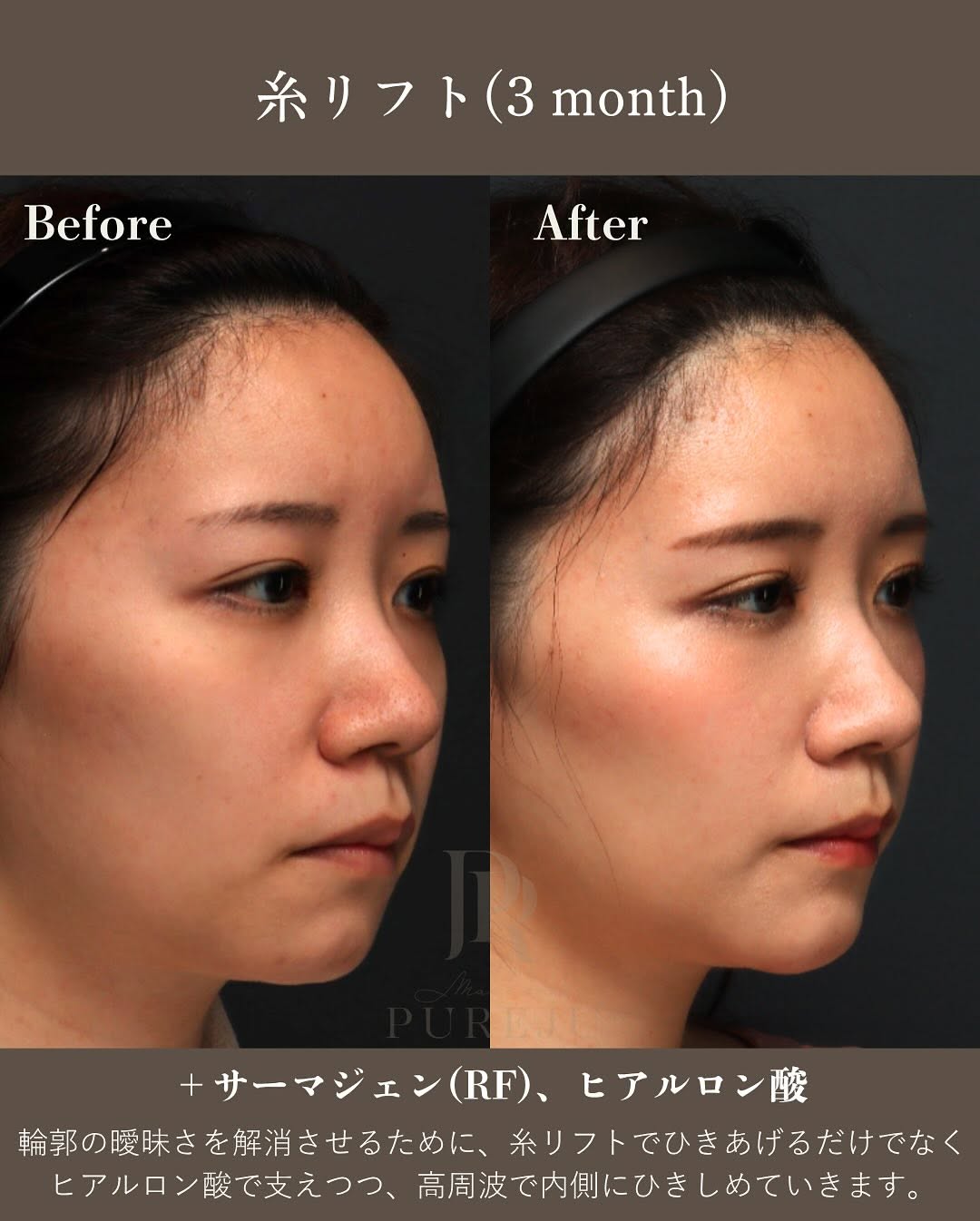 糸リフト×複合治療｜ヒアルロン酸・RF・ショートスレッド・脂肪溶解を組み合わせた輪郭美の作り方 画像3