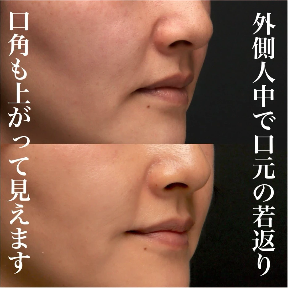 外側人中短縮で唇のかぶさりを改善し本来の口角が見えるようになった症例(術後3ヶ月)