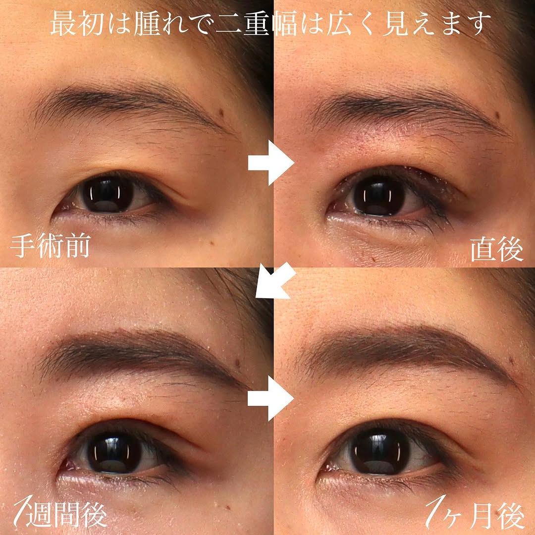 眼瞼下垂手術で黒目の見える範囲が広がり目に入る光が増えた症例（術後1ヶ月） 画像2