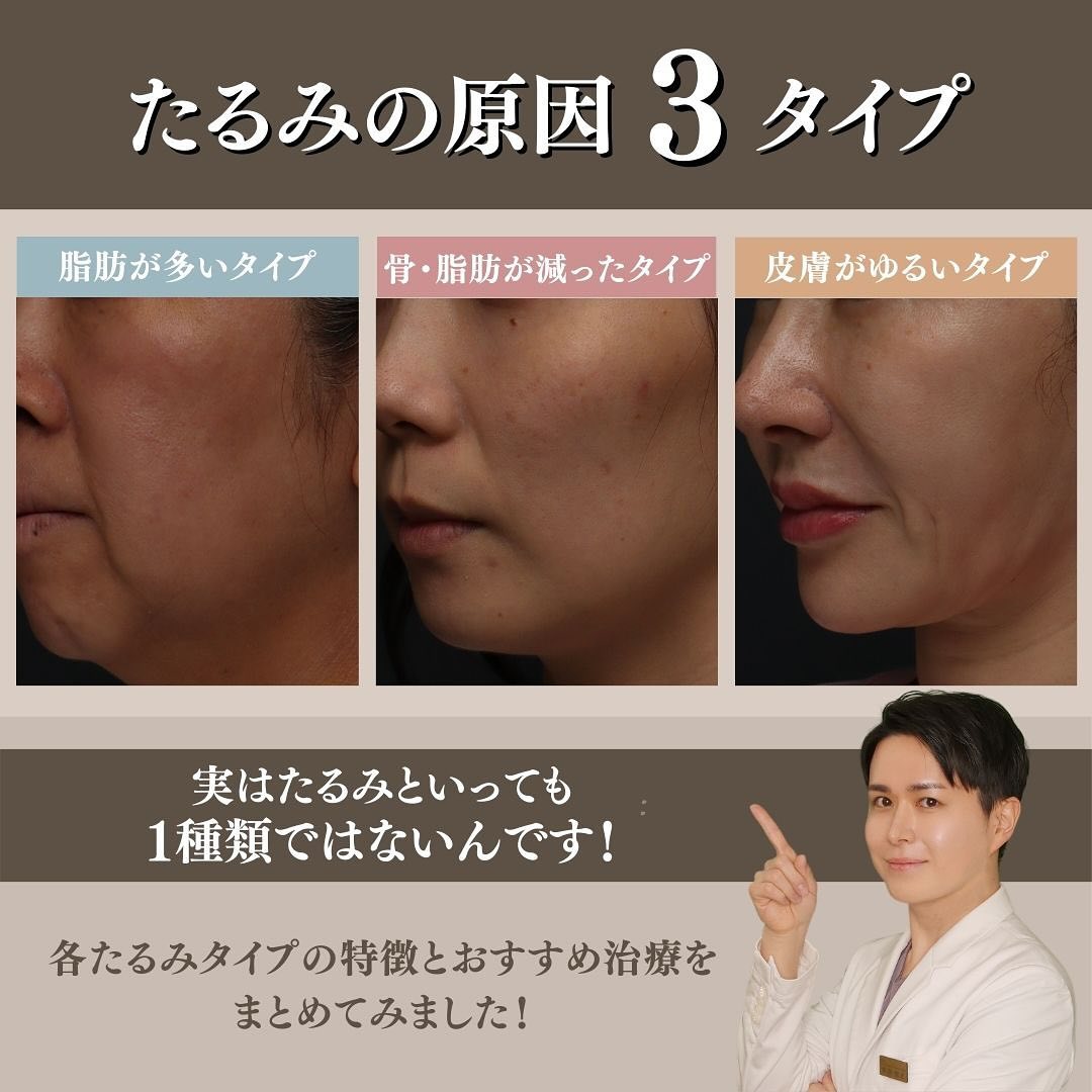 あなたのたるみはどのタイプ？原因3タイプ別おすすめ治療を医師が解説 画像2