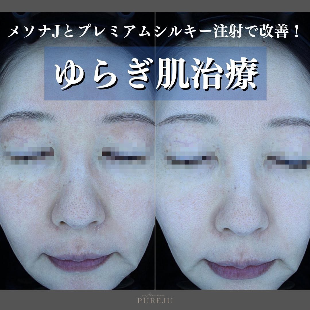 ゆらぎ肌の原因と治療｜赤みの種類（乾燥・炎症・真皮の衰え・血管拡張）で選ぶアプローチ