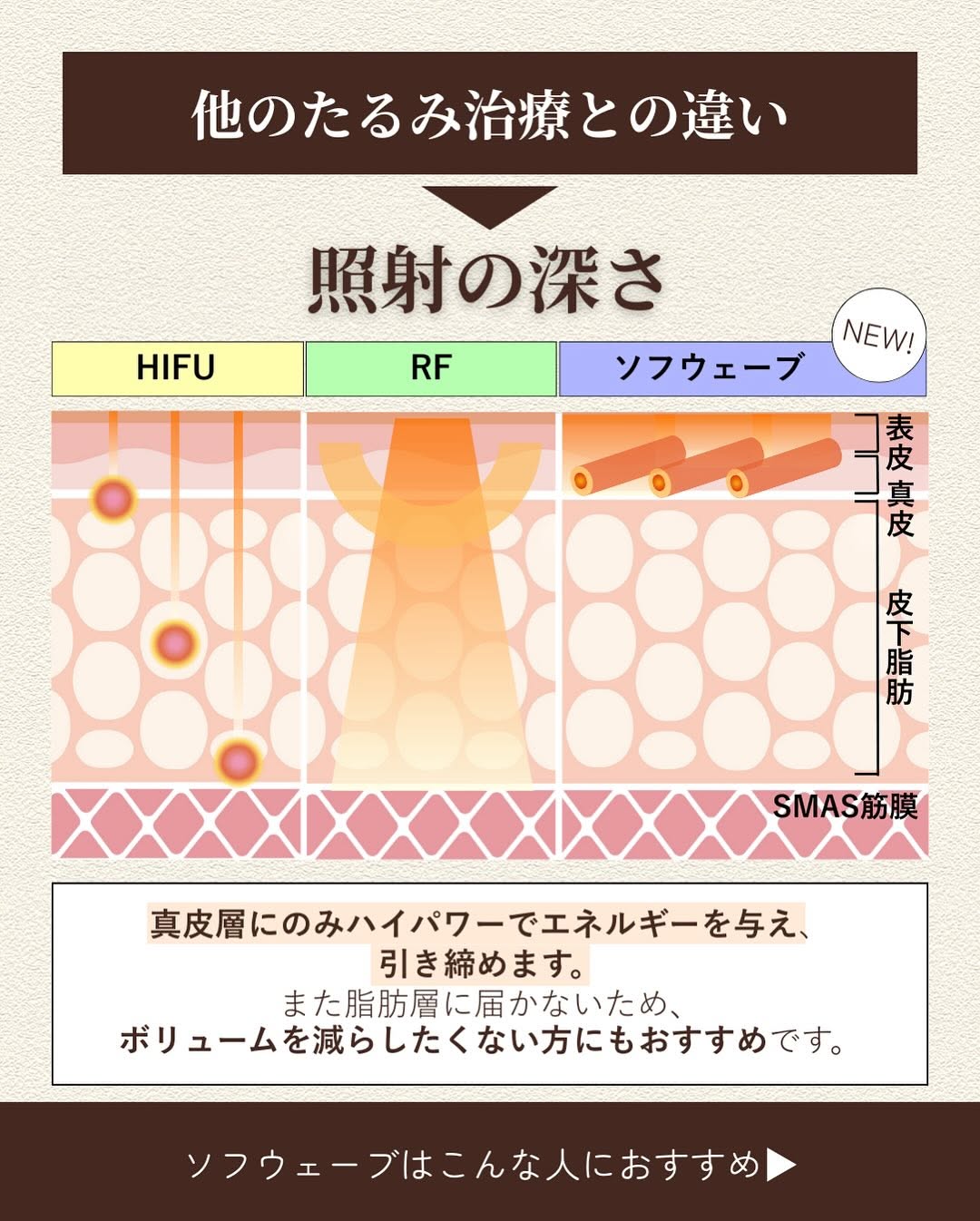 ソフウェーブで目周りの小じわをアイロンのようにピンと伸ばした症例 画像3