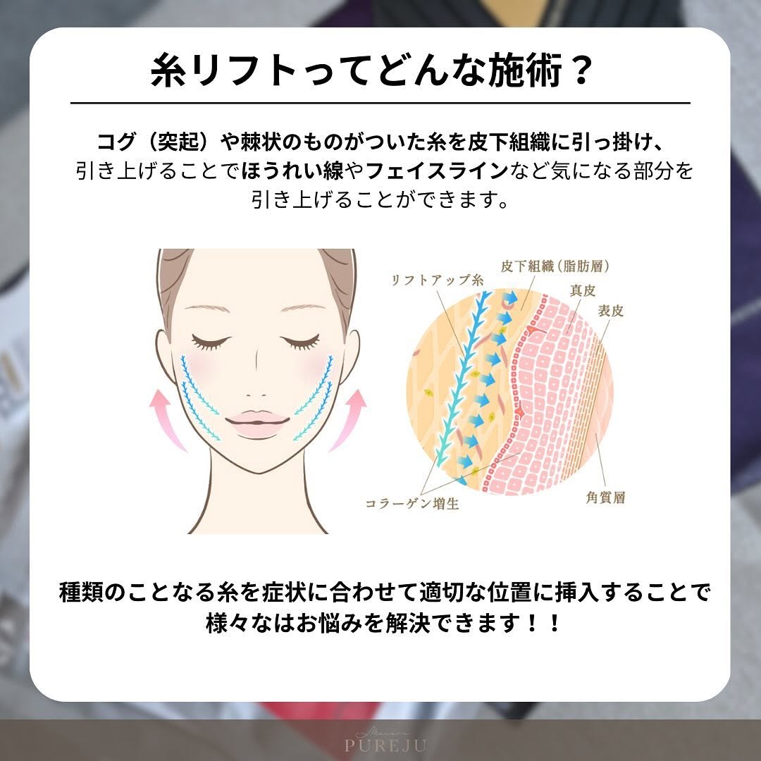 糸リフトとは｜種類・材質・本数の目安からMaison PUREJUの3プランまで徹底解説 画像2