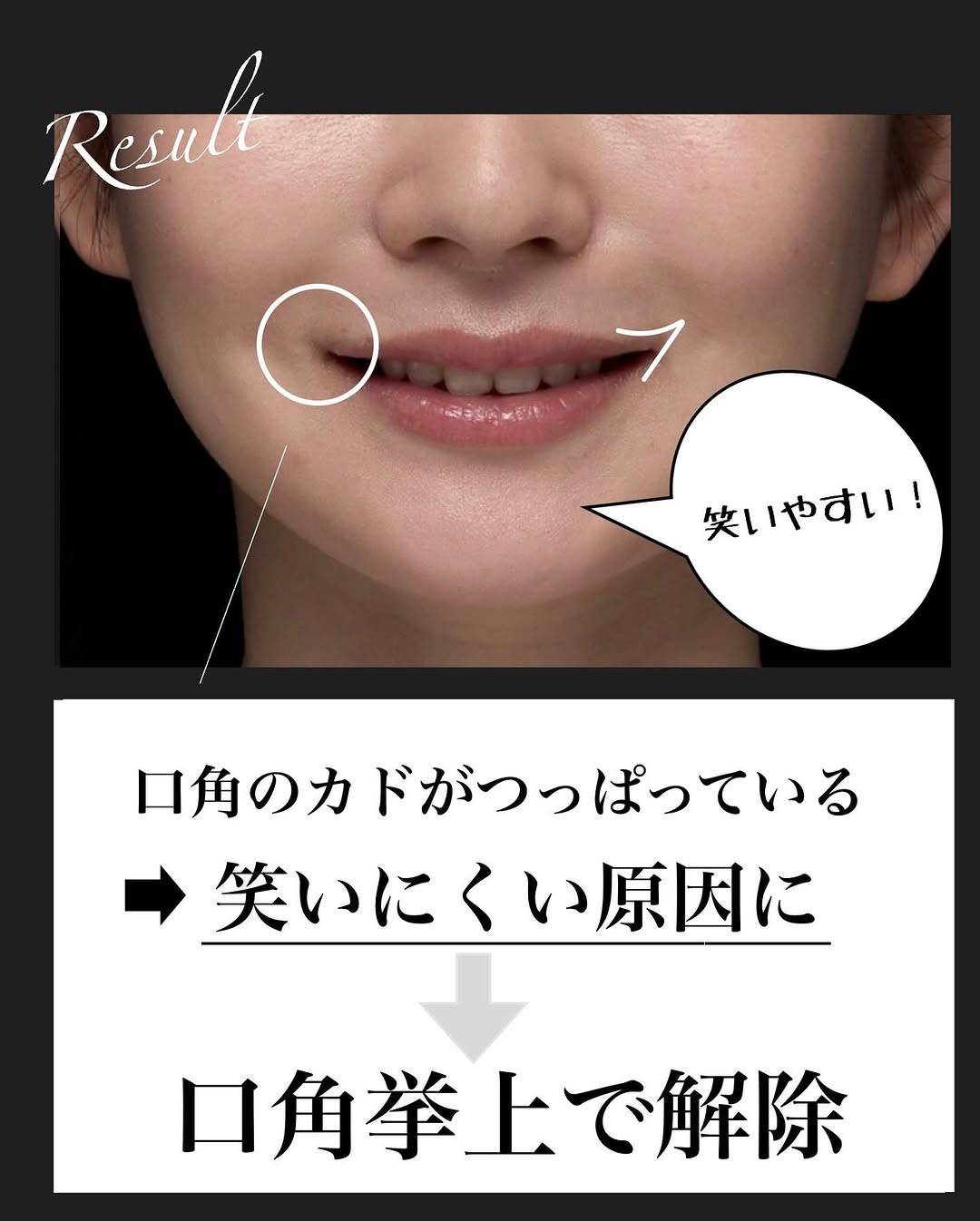 口角挙上＋ヒアルロン酸で術後6ヶ月笑顔が格段に良くなった症例 画像3