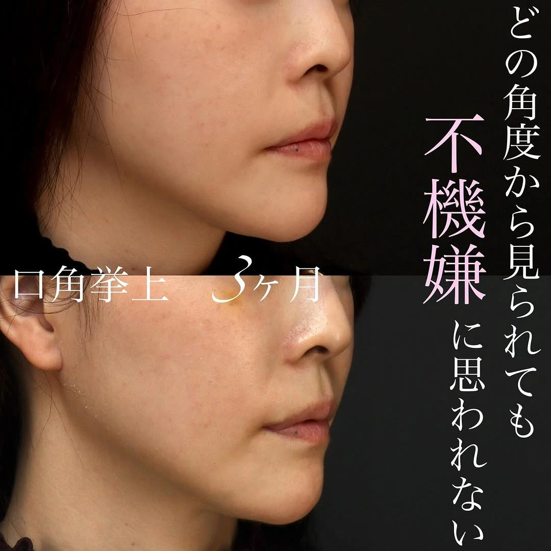 口角挙上でふとした瞬間・斜めから見ても口角が上がっている印象の良い口元に整えた症例