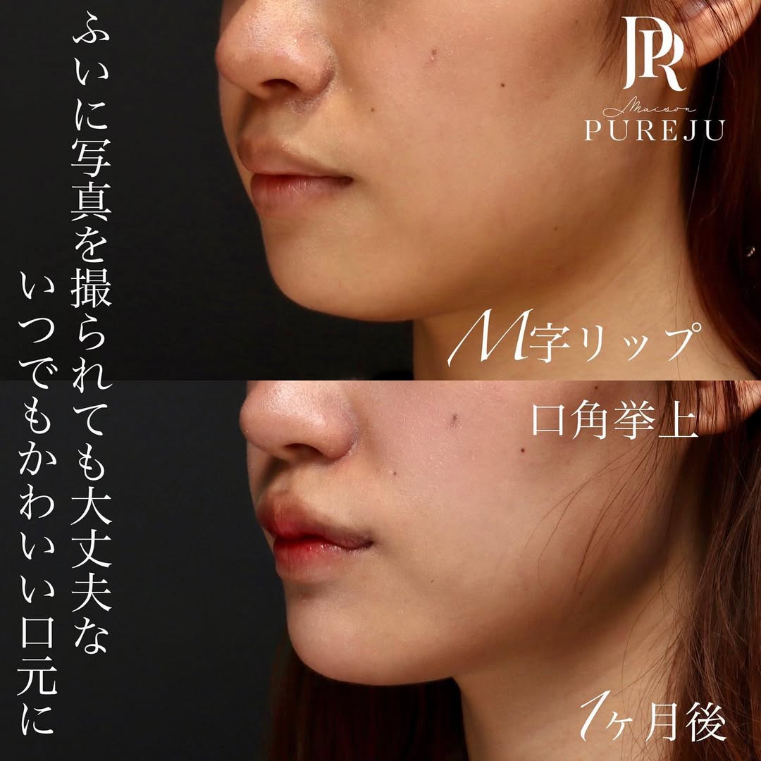 M字リップ×口角挙上でいつ撮られても口角が上がった口元に（術後1ヶ月） 画像2