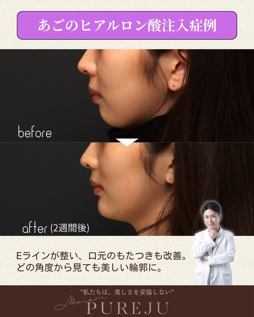 Eライン形成とは｜ヒアルロン酸注入で横顔の美しさを整えるMaison PUREJUの症例と施術 画像2