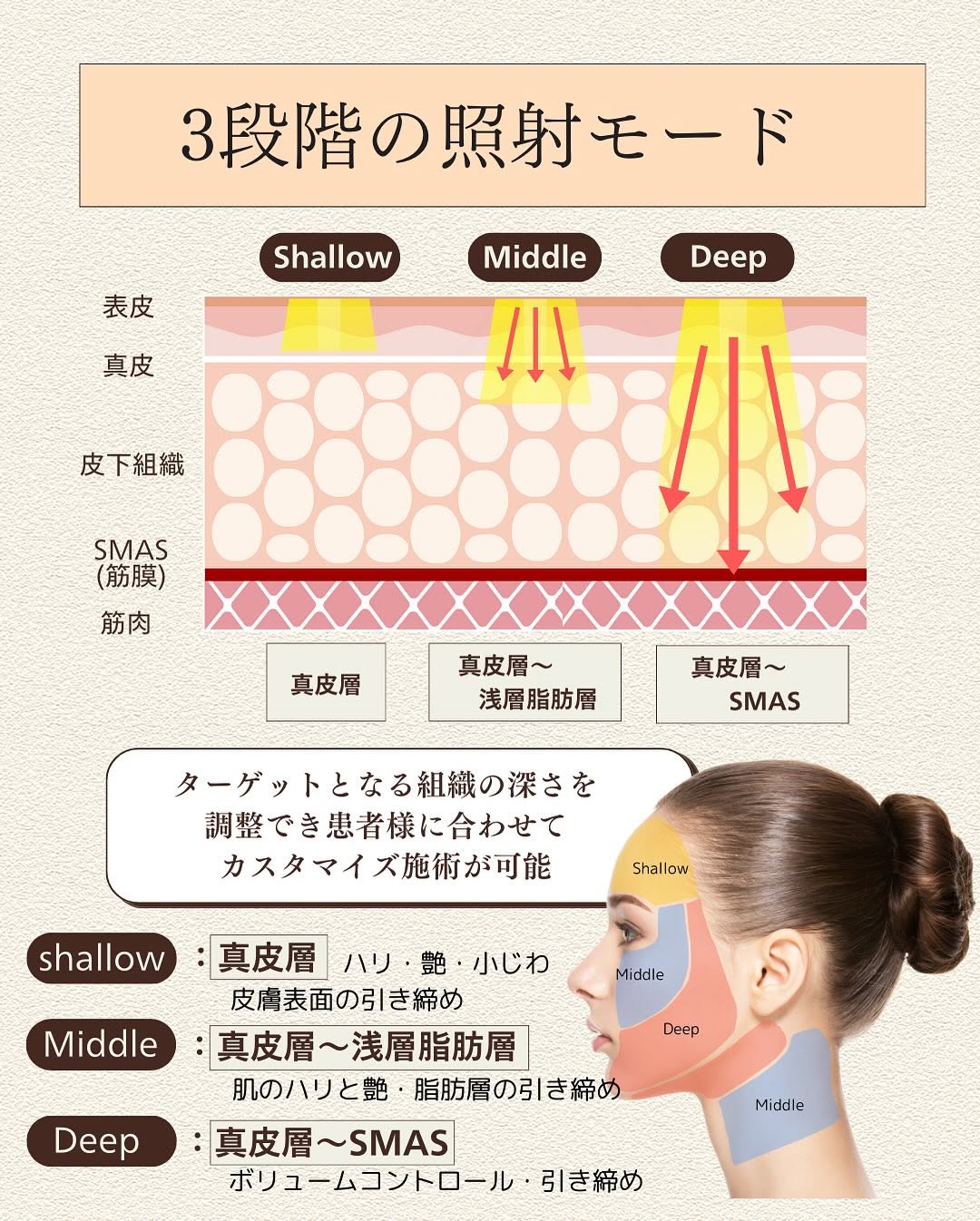 ザーフ（XERF）直後のフェイスラインのピタッとした引き締め効果を実感した症例 画像3
