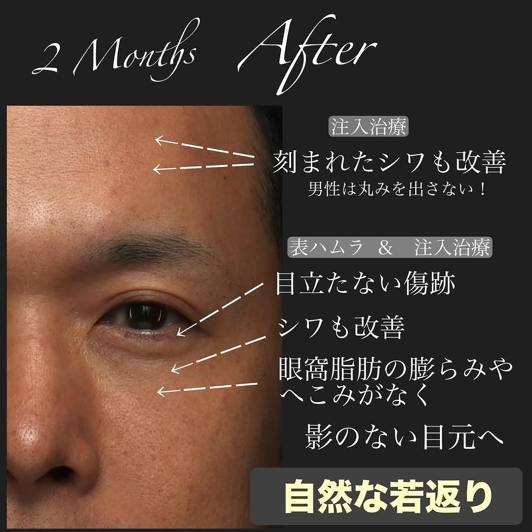 表ハムラ＋ヒアルロン酸注射＋シルキー注射で男性の自然な若返りを実現した症例（半年以上後） 画像2