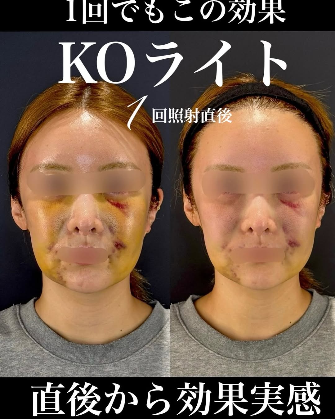 KOライトでゴールデンウィーク手術後の腫れと内出血を軽減したダウンタイム対策症例 画像2
