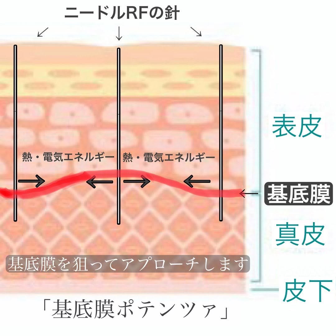 首のアトピー性皮膚炎にポテンツァ×エクソソーム×メソナJで肌の炎症と赤みを改善した症例 画像3