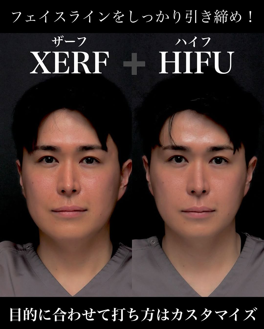 ウルトラセルZi（HIFU）＋ザーフ（RF）の組み合わせでたるみを全層引き締めた症例