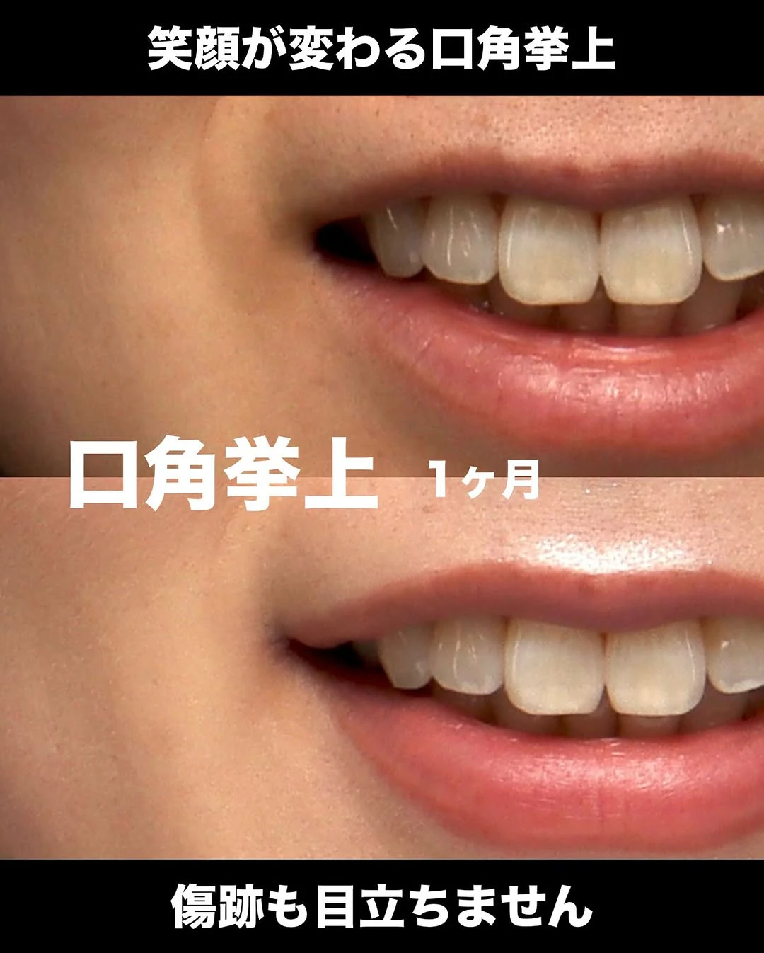 口角挙上でつっぱりが解除され笑顔がかわいくなった症例