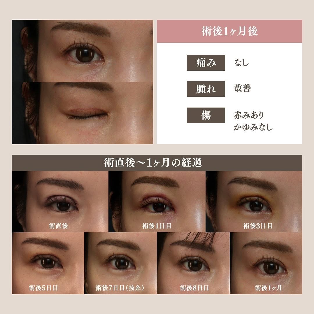 二重全切開（修正）のダウンタイムはどのくらい？術直後〜1ヶ月の経過と過ごし方を解説 画像6