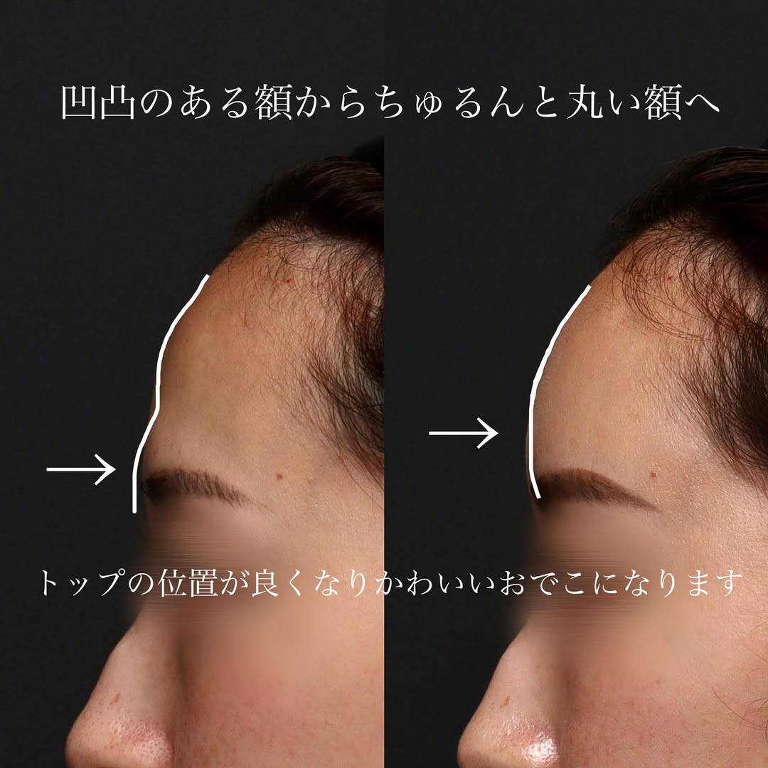 額・こめかみへのヒアルロン酸注射で顔に丸みと女性らしい柔らかい印象を出した症例 画像4