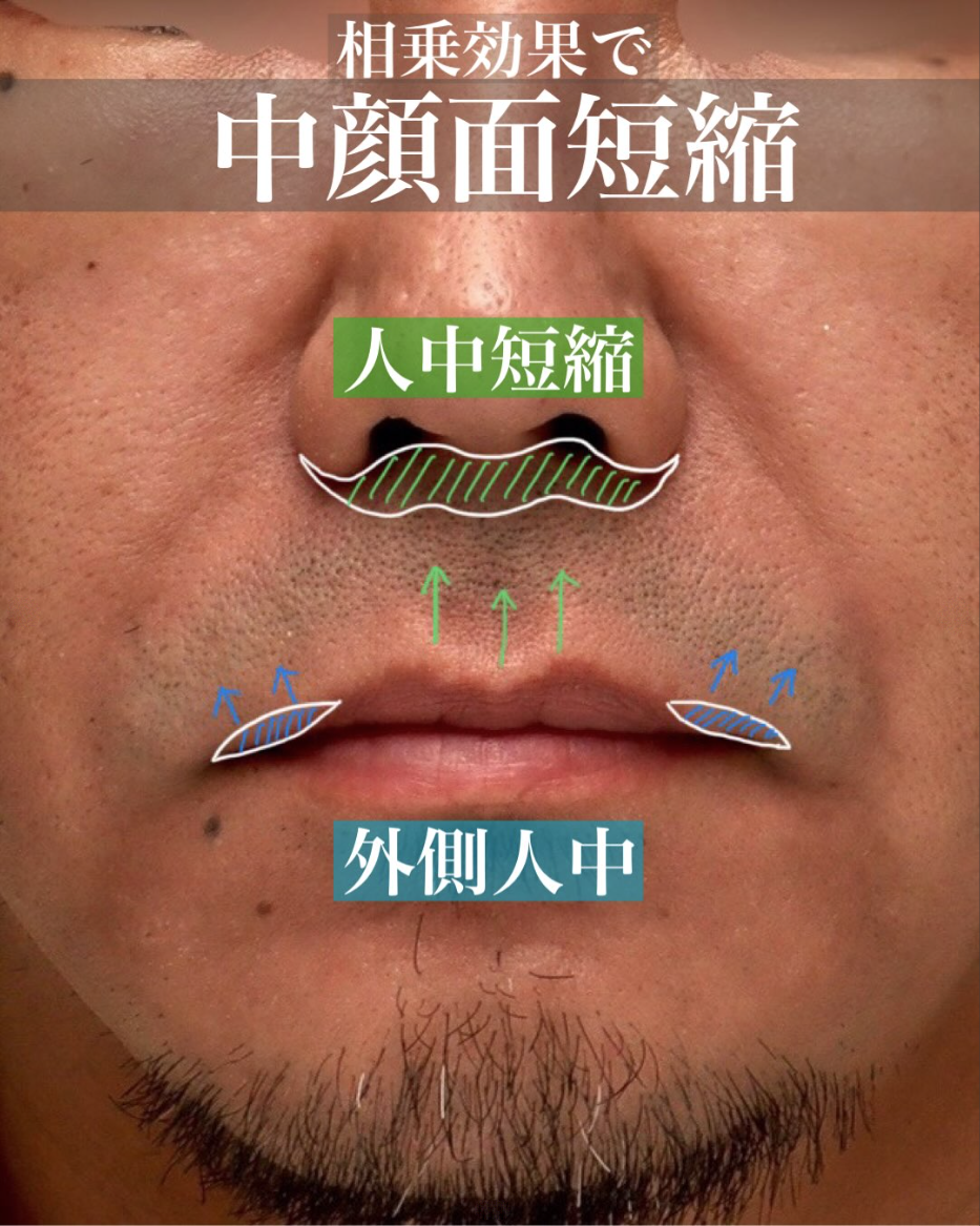 人中短縮＋外側人中短縮＋ヒアルロン酸＋ボトックスで中顔面を短縮し若返らせた男性症例（術後1ヶ月） 画像2