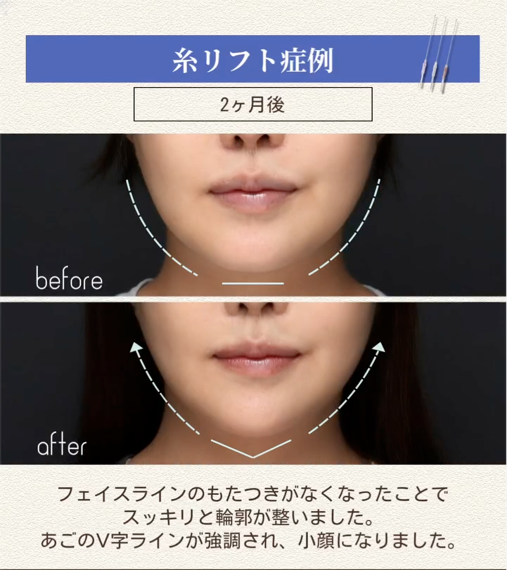 糸リフトでフェイスラインを引き上げあごのVラインを整えた症例（2ヶ月後） 画像2