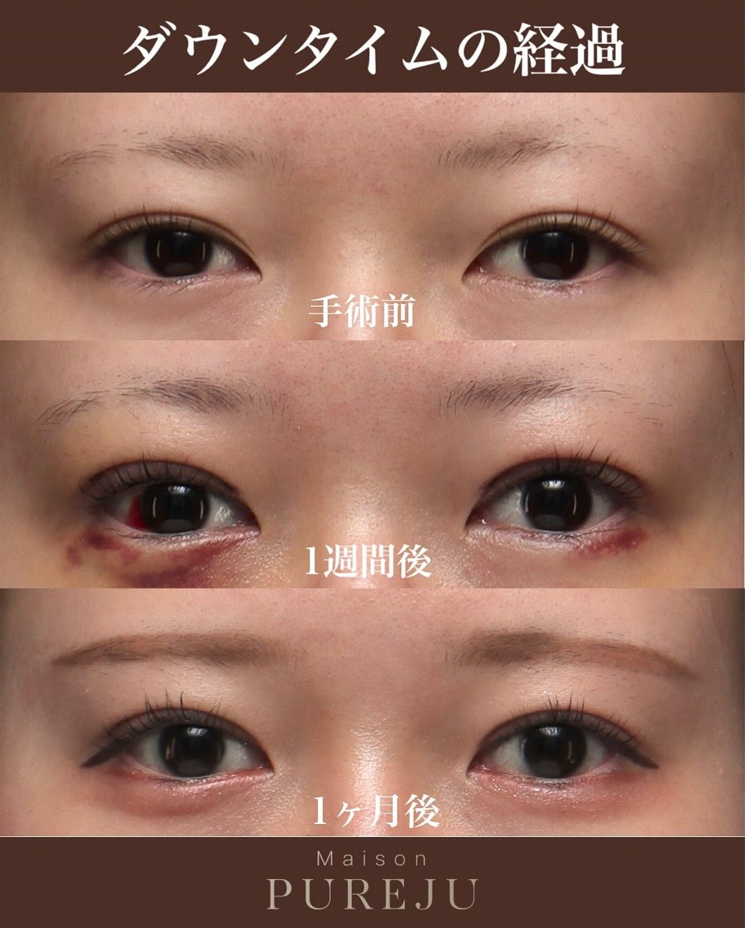 眼瞼下垂手術で隠れた黒目を見せ目の開きと印象を大きく改善した症例 画像4