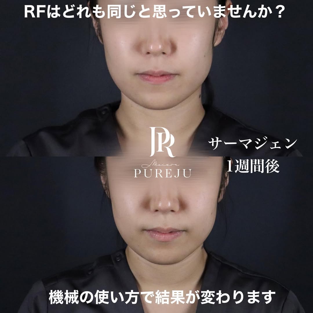 サーマジェン（RF）でフェイスラインを引き締めたるみを改善した症例