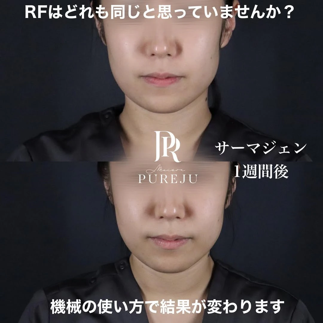 サーマジェン(RF)でフェイスラインを引き締めたるみを改善した症例