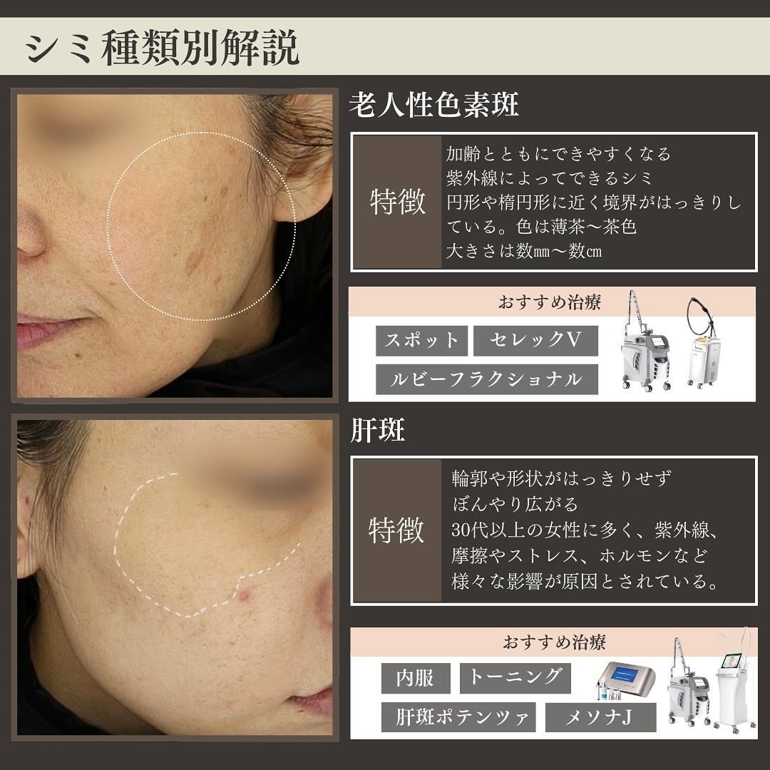 シミの種類4つを徹底解説｜ADM・そばかす・老人性色素斑・肝斑の特徴とおすすめ治療 画像3