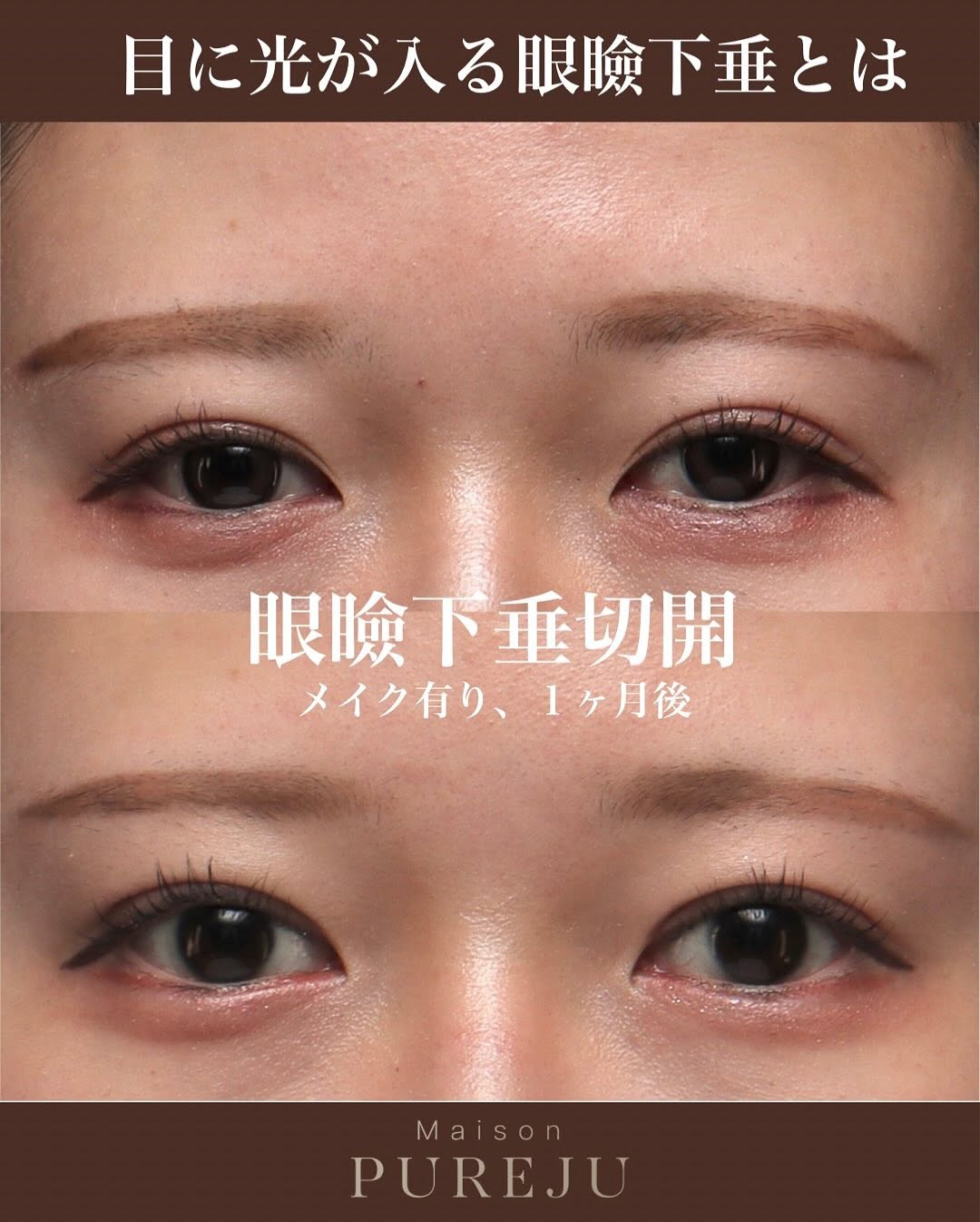眼瞼下垂手術で隠れた黒目を見せ目の開きと印象を大きく改善した症例