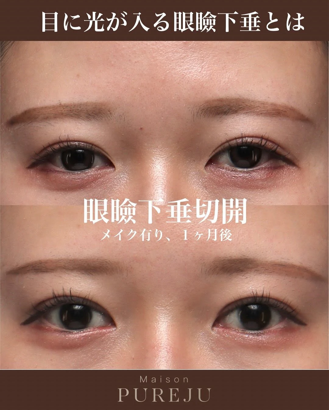 眼瞼下垂手術で隠れた黒目を見せ目の開きと印象を大きく改善した症例