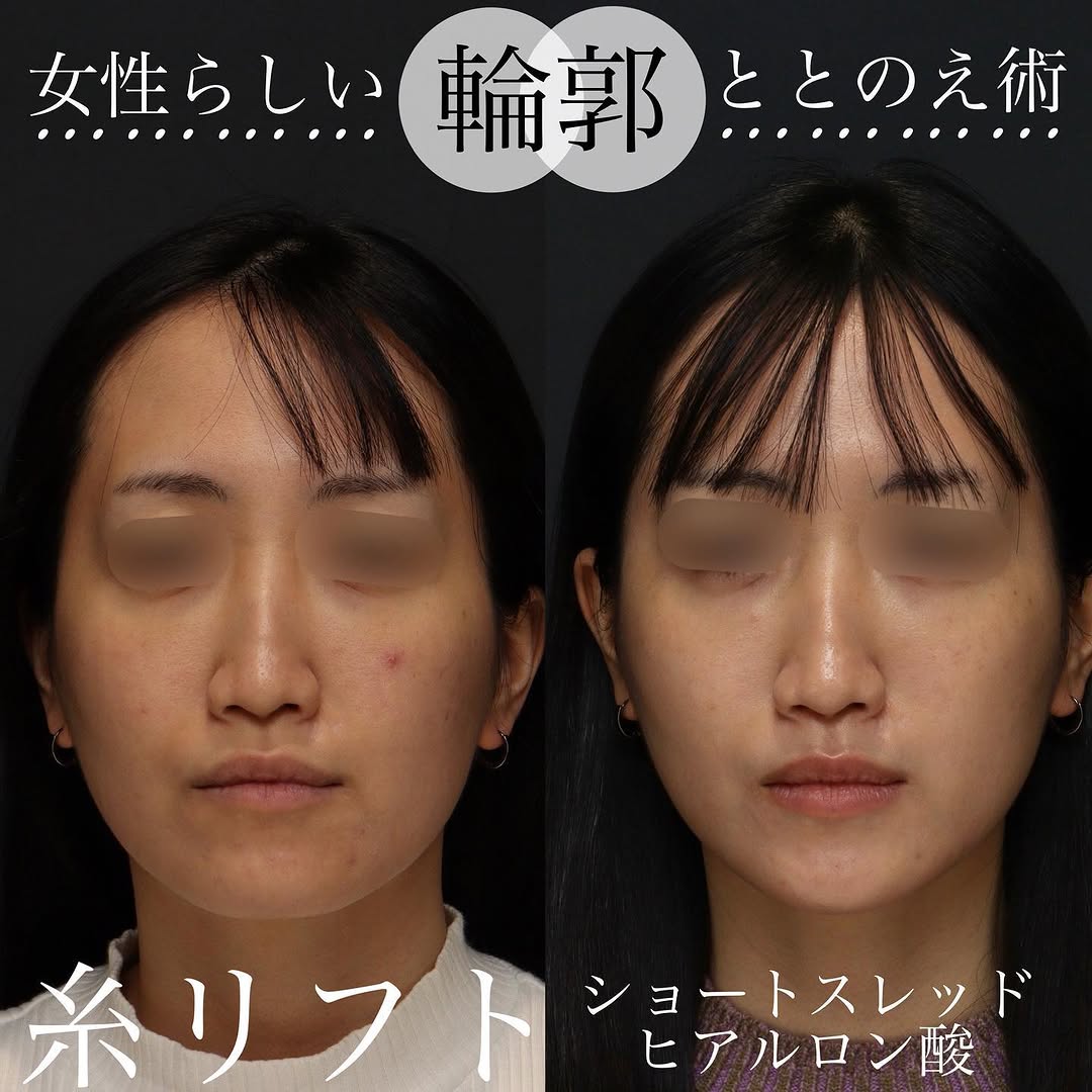 糸リフト＋ショートスレッド＋ヒアルロン酸でフェイスラインをすっきり整えた症例