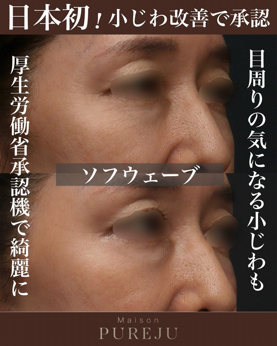 ソフウェーブで小じわとたるみを真皮から改善した症例（別角度からの経過）