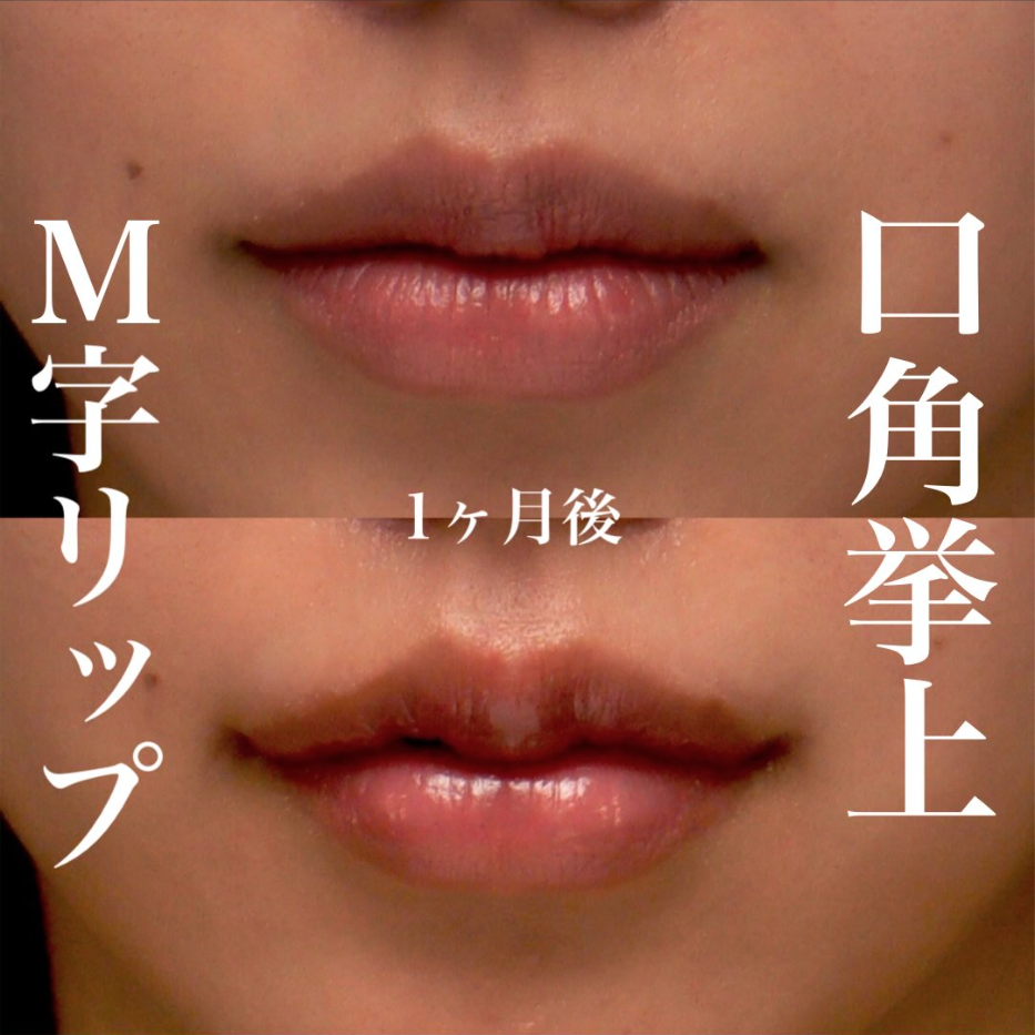 M字リップ＋口角挙上で唇の比率を整え立体感のある口元にした症例（術後1ヶ月）