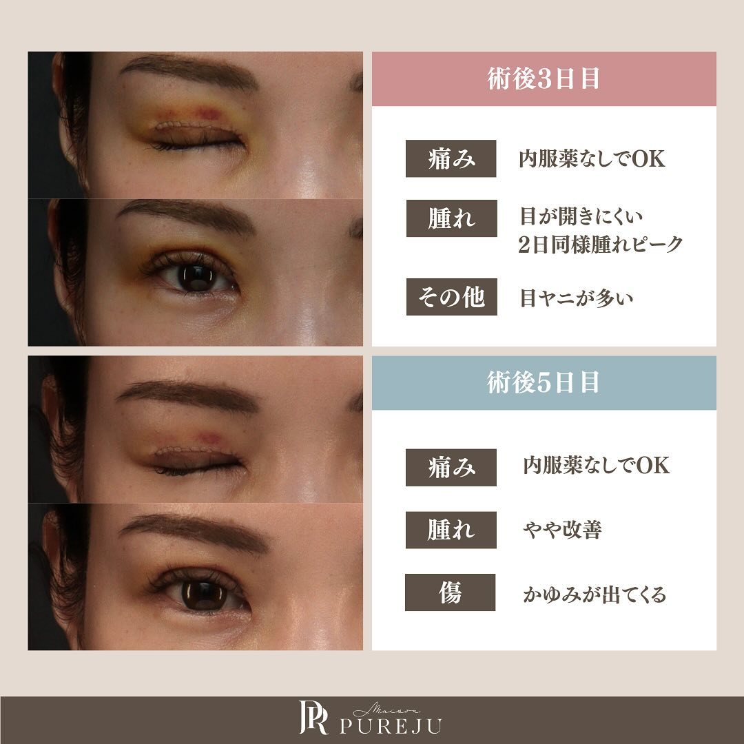 二重全切開（修正）のダウンタイムはどのくらい？術直後〜1ヶ月の経過と過ごし方を解説 画像4
