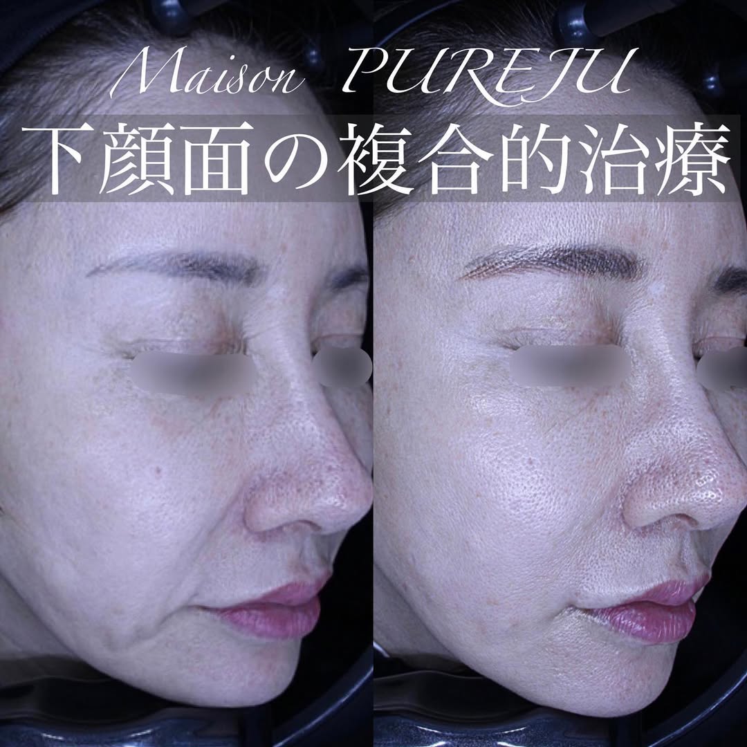 ジャルプロ＋ショートスレッド＋シルキー注射＋口角挙上の複合治療で口横のたるみを整えた症例 画像5