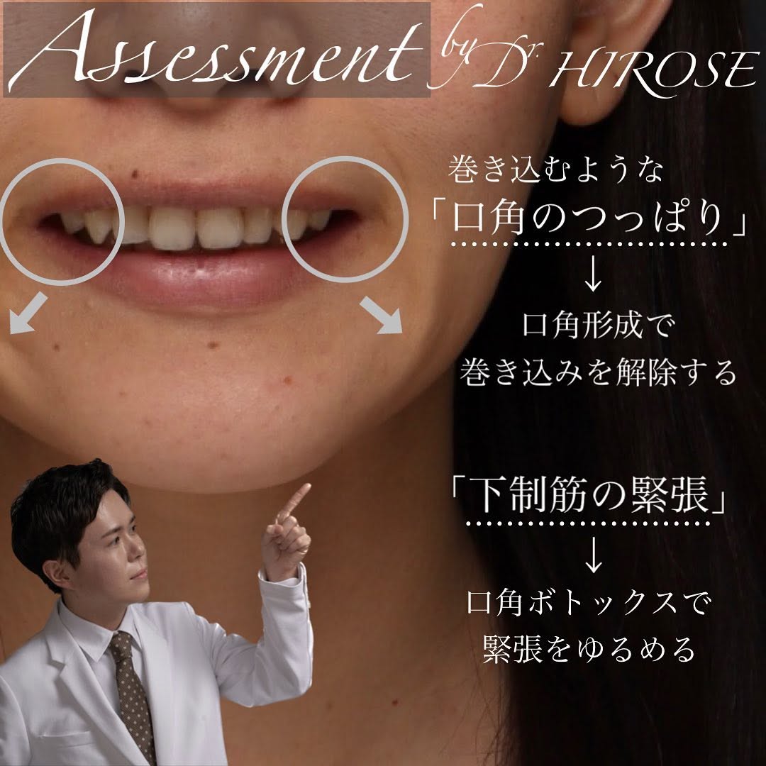 口角形成で笑顔がきれいになりぎこちなさが改善した症例 画像3